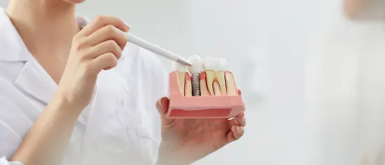 Eine Zahnärztin zeigt ein Implantat-Modell für eine mögliche Zahnzusatzversicherung mit Implantaten